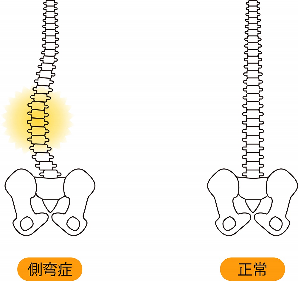 脊柱側弯症とは？症状は？