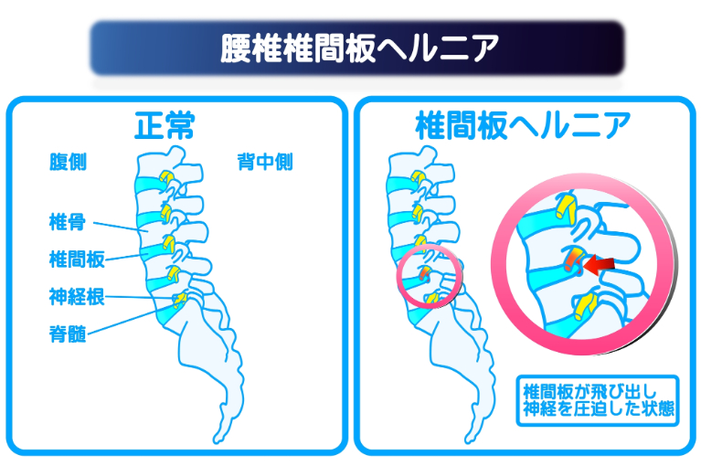 椎間板ヘルニア