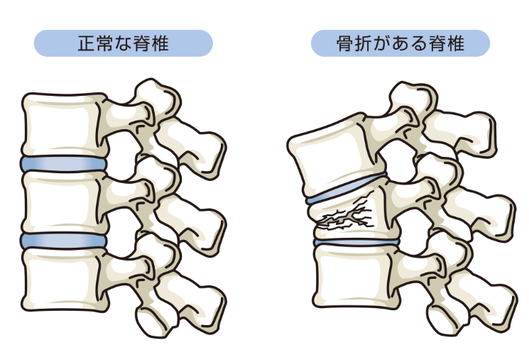 椎体骨折