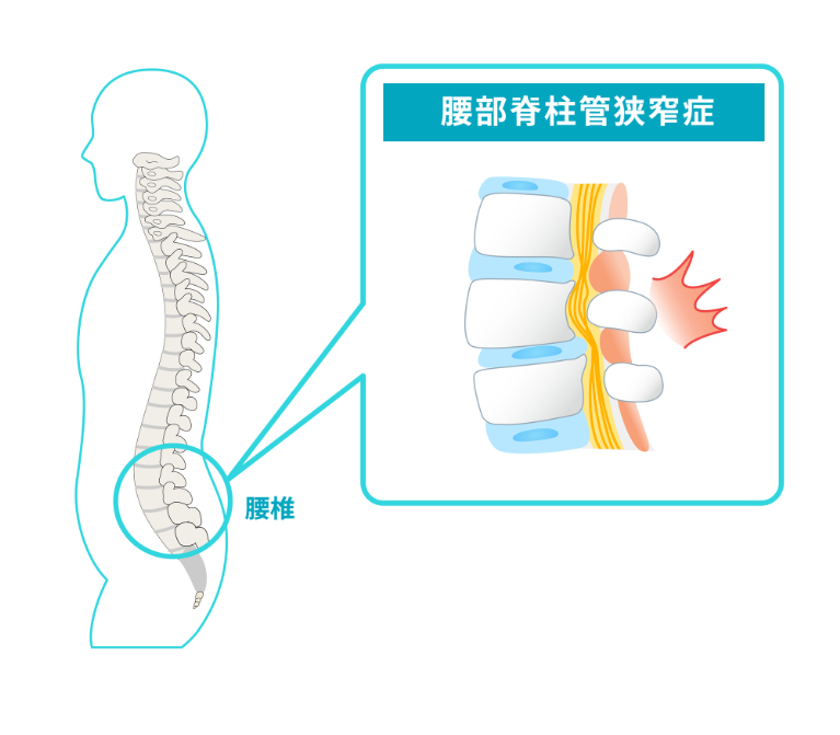 腰部脊柱管狭窄症