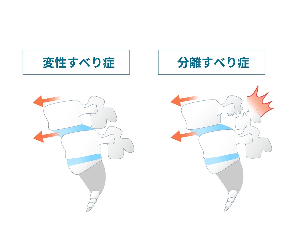 すべり症とは？種類は主に３つ